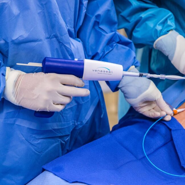 VenaSeal™ Glue Therapy