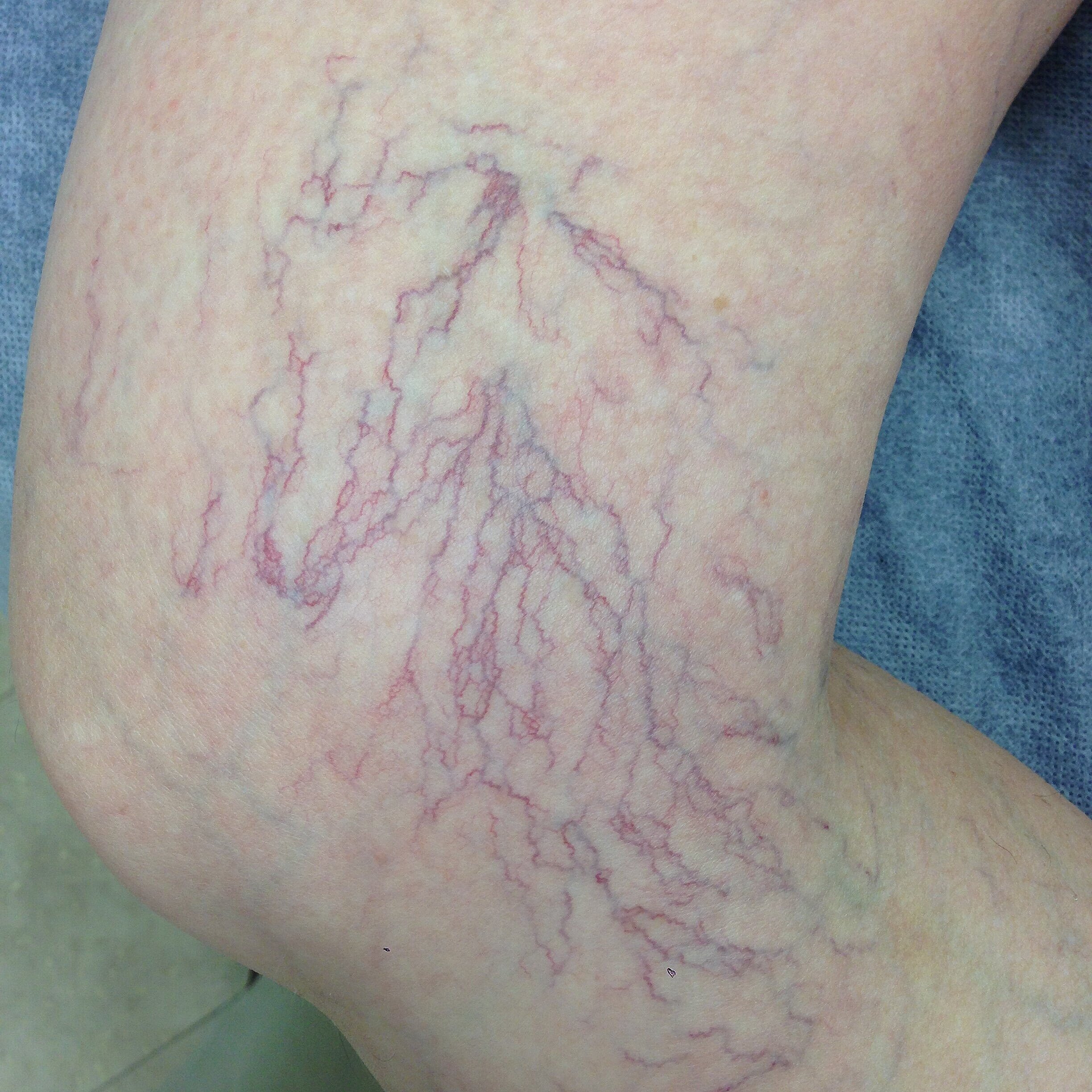 Spider Veins