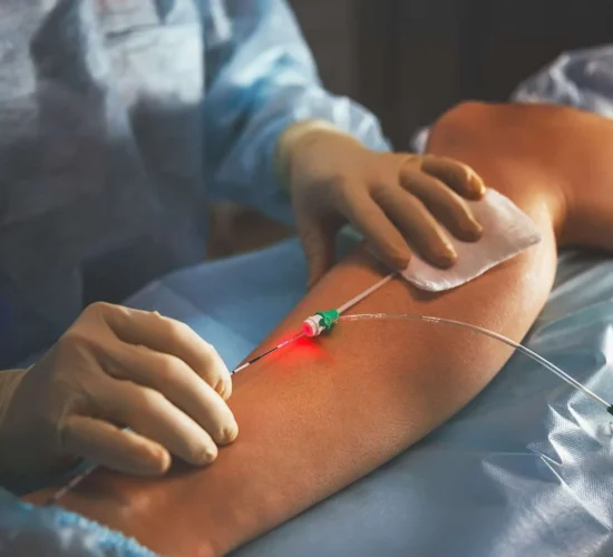 Endovenous Laser Ablation