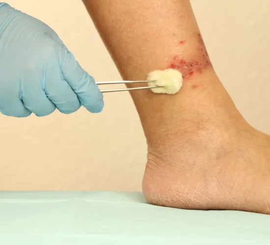 Venous Ulcer Management