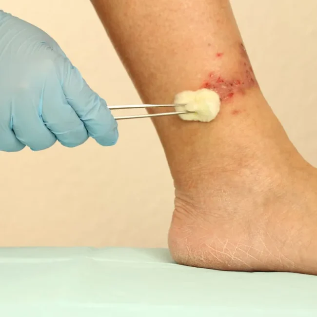 Venous Ulcer Management