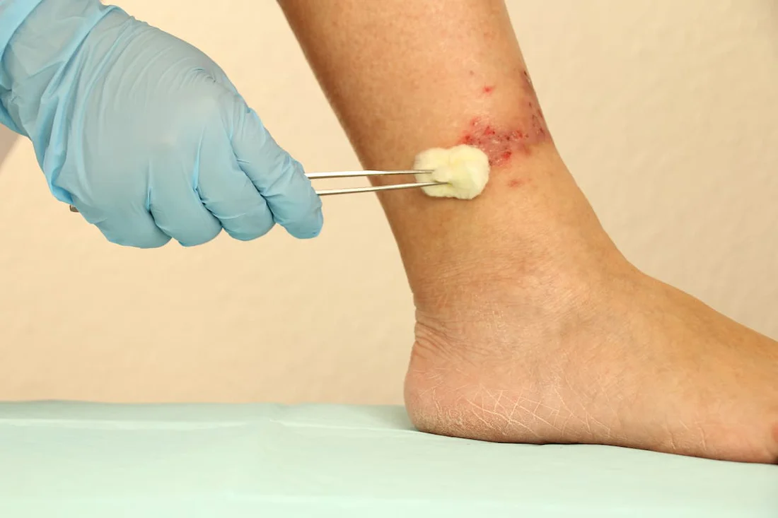 Venous Ulcer Management